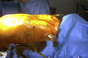 Dos tubos pleurales en cada hemitórax para recircular la solución fría de preservación.