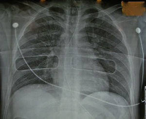 Radiografía del tórax de un donante en asistolia válido.