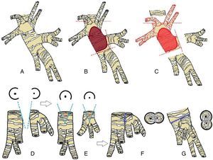 A) Anatomía bronquial izquierda, vista lateral. B) Área de infiltración bronquial. C) Resección de área bronquial afectada separando bronquios segmentarios de LII. D, E) Incisión en cuña sobre el bronquio de la pirámide basal y el bronquio del segmento seis. F) Anastomosis latero-lateral entre bronquios segmentarios; vista lateral. G) Anastomosis de bronquios segmentarios a bronquio principal izquierdo; vista posterior.