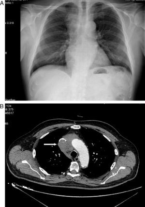 A. Masa mediastínica superior derecha. B. Masa en mediastino superior derecho que infiltraba y ocluía la vena cava superior.