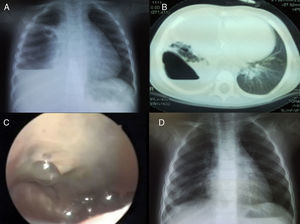 A) Radiografía de tórax en la que se observa una cavidad con nivel hidroaéreo en su interior en hemitórax derecho. B) La TAC preoperatoria muestra lesión compatible con neumonía necrosante abscesificada de lóbulo inferior derecho. C) Imagen intraoperatoria del absceso pulmonar; nótese el aspecto verdoso del parénquima y las burbujas de aire a su alrededor causadas por la FBP. D) Control radiológico a los 2 meses de la cirugía.