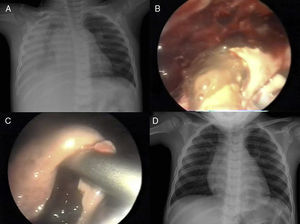 A) Radiografía de tórax preoperatoria con empiema derecho que llega hasta el ápex pulmonar. B) Imagen toracoscópica en la que se aprecia la salida del contenido del absceso. C) Imagen intraoperatoria de la cavidad del absceso tras la evacuación de los detritus. D) Control radiológico a los 2 meses de la cirugía.