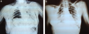 Lesión traumática traqueobronquial. a) Pulmón no visible tras una caída, con enfisema quirúrgico; tubo de tórax colocado en el servicio de urgencias. b) Imagen postoperatoria: enfisema quirúrgico en resolución, múltiples fracturas costales.