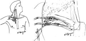 Posición del paciente para realizar la incisión cutánea: miembro superior en abducción y el cuello rotado 45-60° hacia el lado contralateral. Detalle del control distal de los vasos subclavios mediante la separación de los haces musculares del pectoral mayor con un separador autoestático y la posterior sección del músculo pectoral menor.