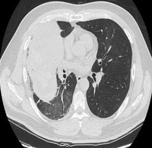 Tomografía computarizada toracoabdominal con masa pulmonar en el lóbulo superior derecho.