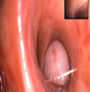 Bronquio segmentario anterior del lóbulo superior derecho con tumor.