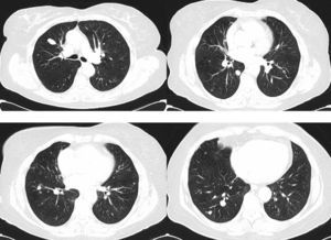 Varios cortes de TAC torácica muestran nódulos pulmonares múltiples bilaterales de tamaño variable.