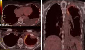 Imágenes de fusión de la PET-TC en la que se observan 2 focos de hipermetabolismo patológico en la zona apical pleural izquierda (SUV 6,8g/ml) y en la subpleural basal izquierda (SUV 3,8g/ml).