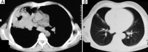 A) La tomografía computarizada (TC) de la ventana mediastínica demuestra una masa de densidad de tejido blando, localizada en el lóbulo medio derecho con cavitación y con consolidación circundante. B) La TC de la ventana pulmonar al cabo de un año de la biopsia en cuña muestra una opacidad fibrótica lineal en el lóbulo medio derecho.
