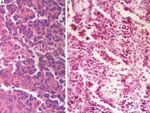 A) La biopsia transbronquial muestra capas de células plasmáticas. B) La biopsia pulmonar abierta muestra células plasmáticas y linfocitos (tinción con hematoxilina y eosina).