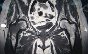 La resonancia magnética potenciada en T1 muestra imagen central y expansiva de características agresivas localizada a nivel del trocánter mayor y cuello de la cadera derecha (flecha).