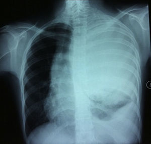 La radiografía de tórax simple en proyección posteroanterior muestra una gran opacidad que ocupa todo el hemitórax izquierdo.