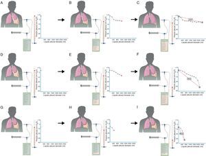 En un derrame pleural con un pulmón normal (2A) la PP inicial será ligeramente positiva. A medida que se retira líquido (2B) la PP descenderá lentamente y el pulmón se irá expandiendo progresivamente. Una vez retirado todo el derrame (2C) el pulmón contactará con la pared torácica y la PEL será normal. En el PPA la pleura visceral tendrá un ligero engrosamiento y la PP inicial será, como en el pulmón normal, ligeramente positiva (2D). Al retirar líquido, en un principio, el pulmón se expandirá progresivamente y la PP descenderá lentamente (2E). Llegado un punto, el pulmón queda atrapado, no se puede expandir más y la PP caerá rápidamente dando lugar a una PEL elevada con una curva presión/volumen bimodal (2F). En el PA, la pleura visceral tiene un capa de fibrina más gruesa que impide que el pulmón se expanda, por lo que la PP inicial será negativa (2G). La retirada de líquido, por un lado, y la rigidez del pulmón, por otro, provocarán un rápido descenso de la PP (2H) que conducirá a una PEL elevada (2I). (Modificado de Feller-Kopman et al.16, con permiso: http://chestjournal.chestpubs.org/site/misc/videos/diagrams1/index.htm).