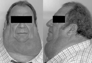 Acumulación simétrica de tejido graso en el cuello de un paciente diagnosticado de lipomatosis simétrica múltiple.