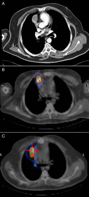 Estudio radiológico. 1A: Tomografía axial computarizada que detectó una masa en mediastino anterior. 1B: SPECT-TAC que confirmó la lesión paracardíaca sospechosa de tumor carcinoide tímico. 1C: SPECT-TAC de la sospecha de recidiva.