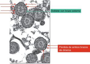 Cambios ultramicroscópicos en la discinesia ciliar primaria.