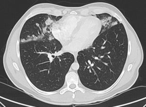 Tomografía computarizada de tórax con nódulos irregulares, acinares e infiltrados alveolares de distribución perilinfática.