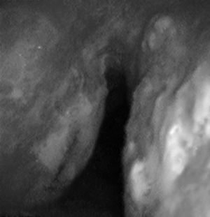 La broncoscopia muestra nódulos en las caras anterior y posterior de la tráquea.