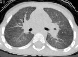 La imagen muestra frecuentes y graves episodios de infección de vías aéreas superiores.