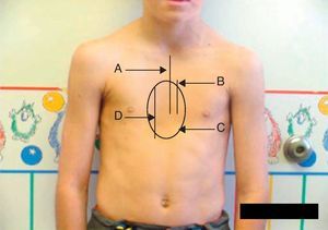 Información sobre el protocolo utilizado para poner de manifiesto la morfología en la fotografía preoperatoria del paciente. A: línea media/esternal del tórax; B: longitud del esternón afectado; C: área afectada por la depresión; D: longitud vertical de la deformidad. Obsérvese que el área está afectada por la asimetría de la depresión hacia la derecha.