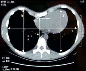 En la TC se muestran las mediciones de la torsión esternal y torácica.