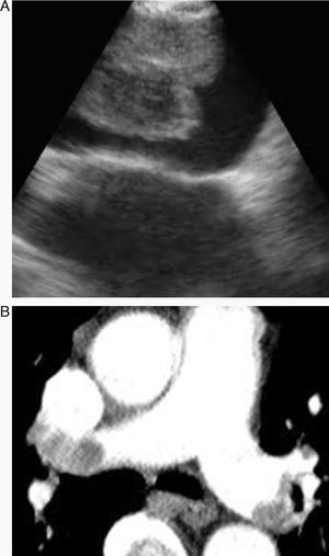 A-B) Imágenes de una embolia en la arteria pulmonar derecha en la EBUS.
