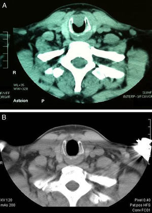Tomografía computarizada (TC). A) Lesión subglótica que ocupa la vía aérea. B) Imagen del mismo caso un año después de laringotraqueoplastia.