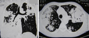 La tomografía computarizada torácica revela una consolidación en ambos pulmones con broncograma aéreo.
