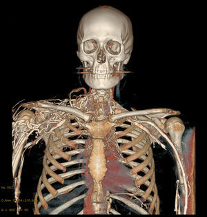 Reconstrucción angiográfica en 3D en la que se muestra el patrón de circulación colateral por compresión de la vena cava superior.