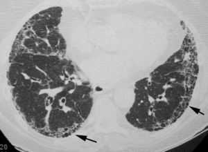 El corte de TCAR a nivel de las bases pulmonares muestra un patrón reticular de localización subpleural y la presencia de múltiples quistes de pequeño tamaño que representan áreas de panalización asociada (flechas).