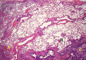 Patrón de neumonía intersticial usual en la biopsia pulmonar: fibrosis periférica (A) con focos de actividad fibroblástica en áreas de interfase (B) y focos de micropanal (C).
