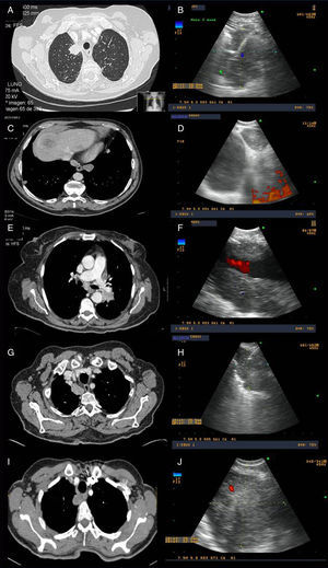 Ejemplos de imágenes radiológicas y sonográficas de 4 de los casos de la serie. A y B: Imágenes de tomografía computarizada (TC) y ecoendoscópica de una masa localizada en el lóbulo superior derecho puncionada por ecobroncoscopia, con resultado de adenocarcinoma de origen pulmonar. C y D: Imágenes de TC y ecoendoscópica de un paciente con una lesión pulmonar en lóbulo inferior izquierdo y una adenopatía en la estación mediastínica 9 derecha, puncionadas ambas por ecobroncoscopia a través del esófago con resultado en las 2 de metástasis de carcinoma de colon. E y F: Imágenes de TC y ecoendoscópica de una masa hiliar izquierda que engloba la arteria pulmonar con punción guiada por ecobroncoscopia diagnóstica de adenocarcinoma de origen pulmonar. G y H: Imágenes de TC y ecoendoscópica de una masa paratraqueoesofágica derecha de posible origen en el lóbulo superior derecho con diagnóstico tras punción realizada a través del esófago de adenocarcinoma de origen pulmonar. I y J: Imágenes de TC y ecoendoscópica de una masa localizada en el lóbulo superior derecho que infiltraba mediastino puncionada por ecobroncoscopia, con resultado de adenocarcinoma de origen pulmonar.