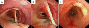 Evolución de la pseudomembrana traqueal. A,B) Pseudomembrana traqueal en forma de tabique longitudinal, adherido en continuidad a la pared anterior y posterior de la tráquea, de 2-3cm de longitud y localizada en el tercio medio traqueal. C) Resolución de la pseudomembrana con presencia de algunos restos de moco.
