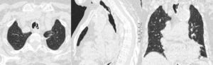 Imágenes radiológicas de la pseudomembrana traqueal en forma de tabique en los cortes transversales y sagitales.