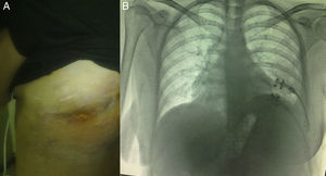 A) Paciente a los 6 meses tras la reconstrucción de la pared torácica. B) Radiografía de control.