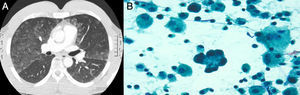 A. TAC tórax: opasidad en vidrio deslustrado, de predomino lóbulos inferiores. B.Lavado broncoalveolar:neumocitos hiperplásicos y eosinofilia significativa.
