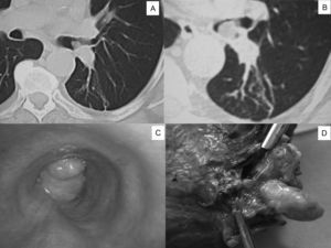 A)En la TAC de tórax se observa lesión endobronquial en el lóbulo inferior izquierdo a nivel de la carina interlobar. B)TAC de tórax un año después: se aprecia un crecimiento de la lesión endobronquial hacia la luz del bronquio principal. C)Fibrobroncoscopia: lesión endobronquial que protruye y ocluye parcialmente la luz del bronquio principal. D)Pieza quirúrgica: lesión polipoide que se origina del bronquio lobar inferior.