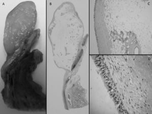 A,B)Neoformación polipoide con base de implantación en la pared bronquial (imagen macroscópica y microscópica). C)Neoplasia constituida por tejido adiposo maduro que engloba estructuras glandulares bronquiales. D)Epitelio de revestimiento de tipo respiratorio.