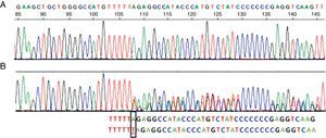 Secuencia correspondiente al exón 5 del gen SERPINA1. A)Secuencia normal. B)Secuencia correspondiente a la paciente, donde se ve la inserción de una timina (T) en vez de una adenina (A) en el codón 376 del exón 5 en heterocigosis, correspondiente al alelo PI-Mattawa. La secuencia codificante del gen SERPINA1 (exones 2 a 5) se analizó utilizando primers previamente descritos para los exones 3 a 5 y primers ex2F 5′ACGTGGTGTCAATCCCTGATCACTG3′ y ex2R 5′TATGGGAACAGCTGG3′ para el exón 2, tomando como referencia comparativa la SERPINA1_Transcript_ENST00000440909.
