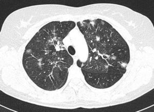 Tomografía computarizada torácica en la que se demuestra un patrón en vidrio deslustrado bilateral, con áreas de consolidación y nódulos pulmonares bilaterales de hasta 1cm de diámetro.