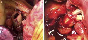 a)Imagen intraoperatoria en la que se puede apreciar el injerto una vez deshecha la sutura con coágulos en el interior. b)Fotografía postoperatoria una vez rehecha la anastomosis.
