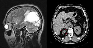 Panel izquierdo: resonancia magnética nuclear del cráneo en la que se observa lesión metastásica con realce del contraste en el lóbulo temporal izquierdo y lesiones inflamatorias perilesionales. Panel derecho: tomografía computarizada del abdomen en la que se observa lesión metastásica de la glándula suprarrenal derecha.
