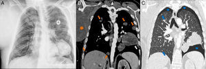 Radiografía (A) y tomografía computarizada (B,C) de tórax en las que se visualizan el sarcoma a nivel húmero-axilar derecho (estrella naranja), masa en pulmón izquierdo (flecha blanca), varios nódulos sólidos (flechas naranjas) y cavitados (flechas azules), así como leve neumotórax bilateral (estrellas azules).