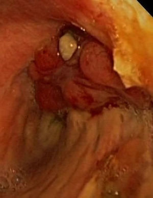 Imagen endoscópica en la que se aprecia una masa polilobulada, con zonas de necrosis, en la zona de muñón de la lobectomía superior derecha.