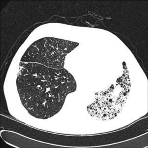 TAC de tórax de un paciente con trasplante pulmonar unilateral derecho por fibrosis pulmonar.