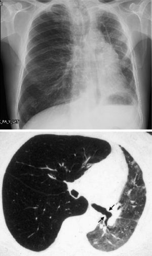 Radiografía de tórax y TAC de tórax de un paciente con trasplante pulmonar unilateral izquierdo por EPOC.