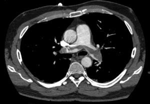 Imagen obtenida mediante angio-TAC de tórax. Se observa un trombo acabalgado entre ambas arterias pulmonares, parcialmente recanalizado, que produce un 25% de obstrucción de las mismas.