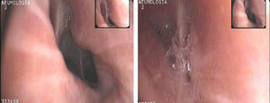 Imagen broncoscópica del lóbulo inferior izquierdo durante la inspiración (izquierda) y durante la espiración (derecha).