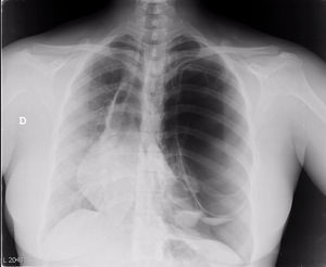 Radiografía simple de tórax posteroanterior. Desplazamiento mediastínico que incluye la silueta cardiaca hacia la derecha, con pérdida de trama broncovascular en el campo pulmonar izquierdo sugestivo de gran bulla y neumotórax apical izquierdo. Imágenes quísticas basales izquierdas con nivel hidroaéreo.