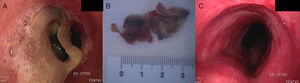 A) Seudomembrana fibrinada en rodete. B) Lesión traqueal. C) Extubación del paciente.